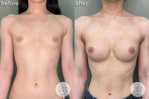 シリコンバッグ豊胸