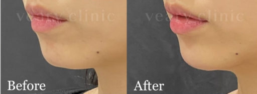 顎ヒアルロン酸