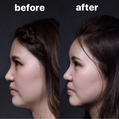 額ヒアルロン酸