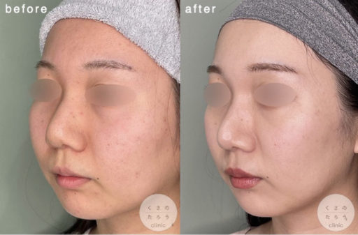 鼻尖形成 耳介軟骨移植