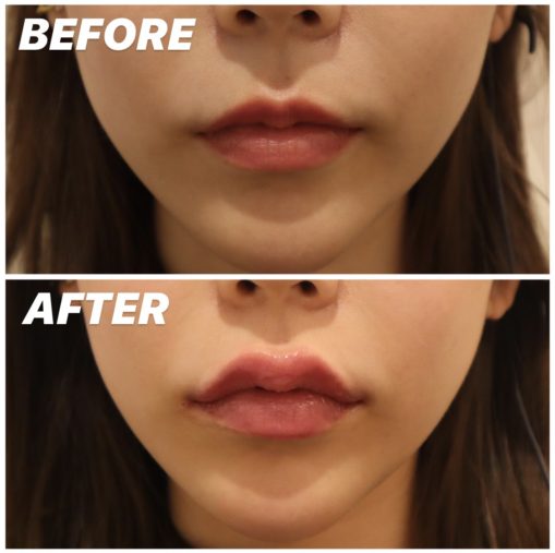 唇ヒアルロン酸