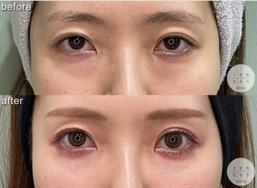 脱脂＋脂肪注入