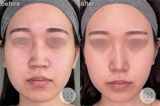 鼻尖形成 耳介軟骨移植