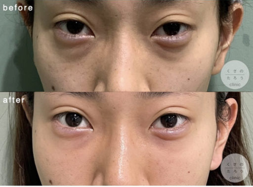 脱脂＋脂肪注入