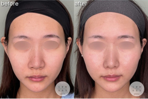 鼻尖形成 耳介軟骨移植 鼻翼縮小