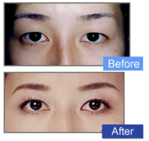 二重埋没＋脱脂