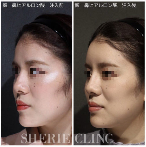 鼻ヒアルロン酸