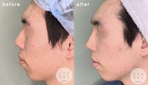 骨切り幅寄せ ハンプ削り 耳介軟骨移植