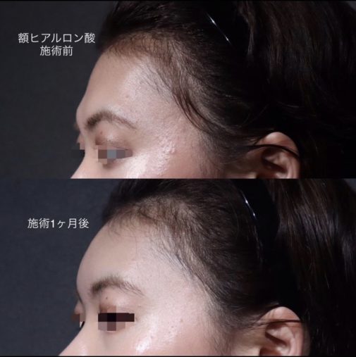 額ヒアルロン酸