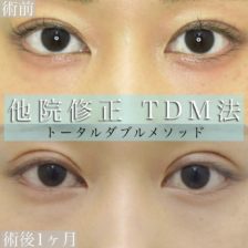 眼瞼下垂<br />
(他院修正)