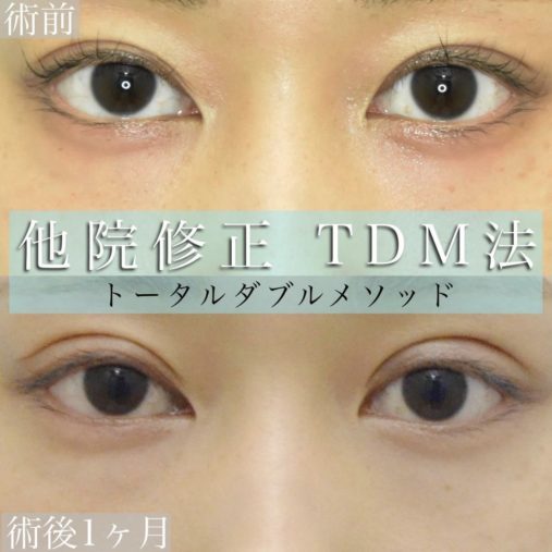 眼瞼下垂 (他院修正)