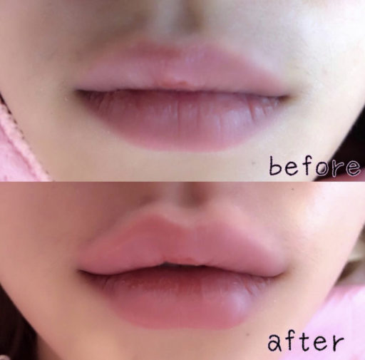 唇ヒアルロン酸