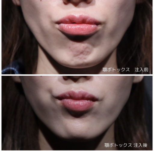 顎ボトックス