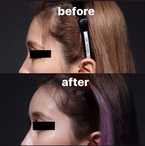 額ヒアルロン酸