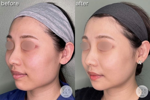 頬骨骨切り エラ骨切り 咬筋切除