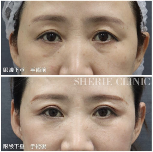 眼瞼下垂