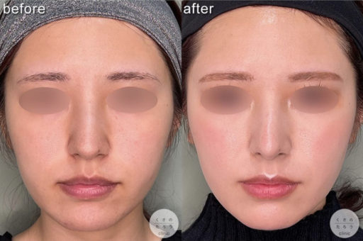 鼻尖形成 耳介軟骨移植