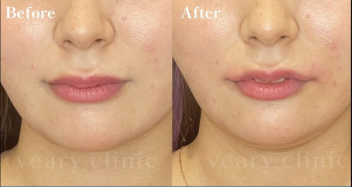 唇ヒアルロン酸