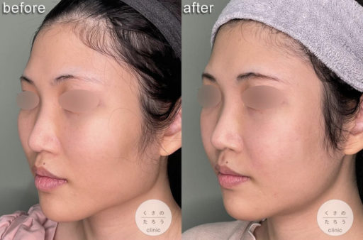 頬骨骨切り エラ骨切り