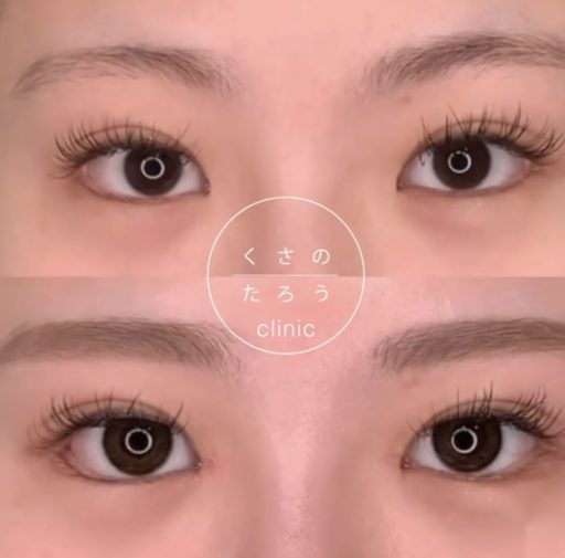 目頭切開 目尻切開 グラマラスライン