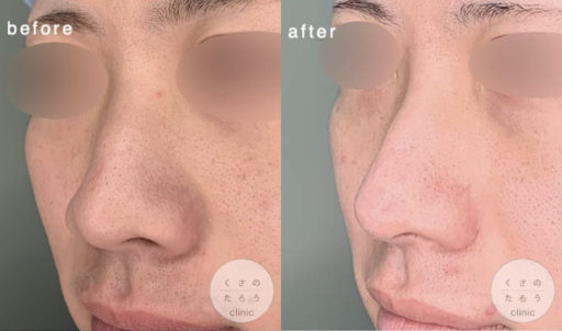 骨切り幅寄せ ハンプ削り 鼻翼縮小 鼻尖形成 耳介軟骨移植
