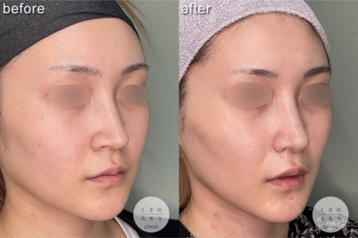 鼻翼縮小 耳介軟骨移植