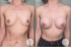 シリコンバッグ豊胸