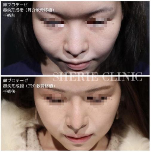 鼻プロテーゼ 鼻尖形成