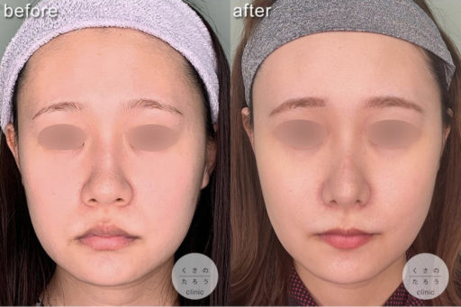 鼻尖形成 耳介軟骨移植 鼻翼縮小