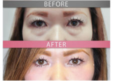 下眼瞼脂肪移動<br />
(裏ハムラ法)