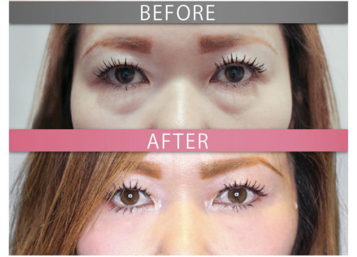 下眼瞼脂肪移動 (裏ハムラ法)