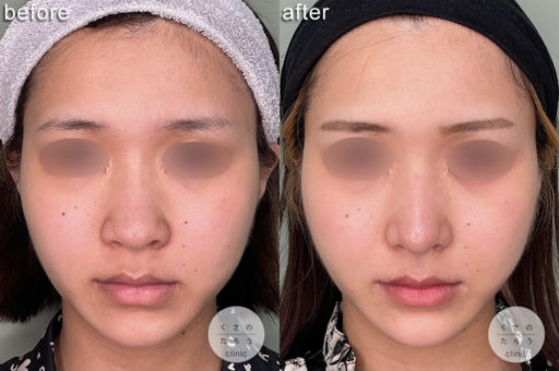 鼻尖形成 耳介軟骨移植 鼻翼縮小