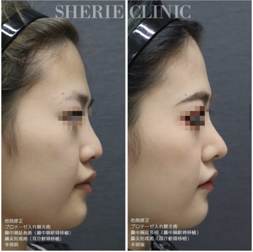 鼻尖形成 鼻中隔延長 プロテーゼ入れ替え (他院修正)