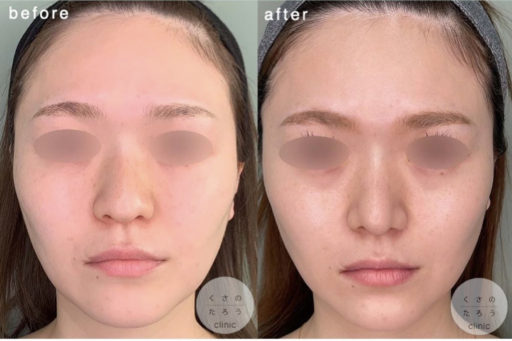 鼻尖形成 耳介軟骨移植