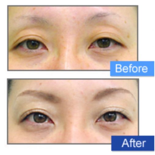 上眼瞼脂肪注入