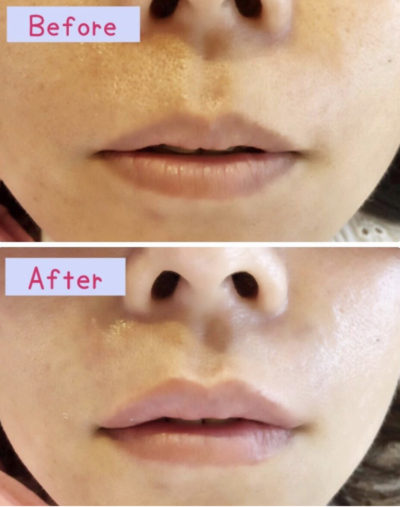 唇ヒアルロン酸