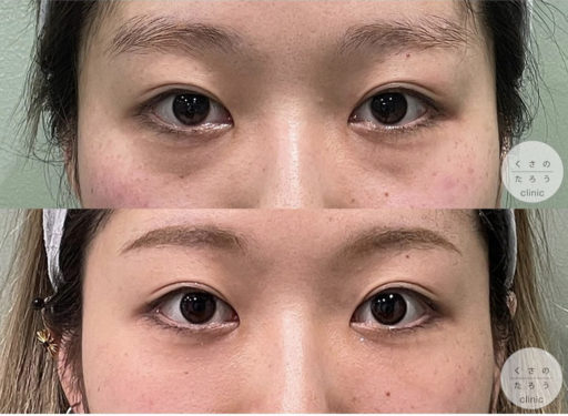 脱脂＋脂肪注入