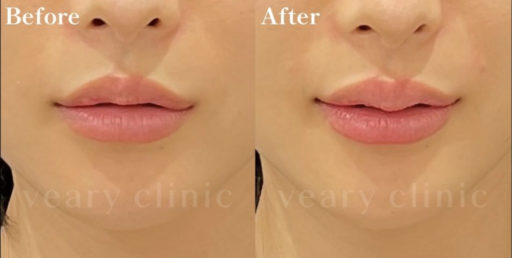 唇ヒアルロン酸