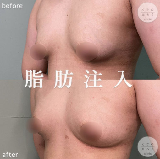 脂肪注入豊胸