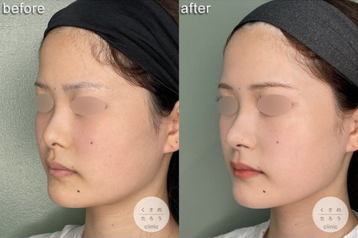 耳介軟骨移植 鼻孔縁下降