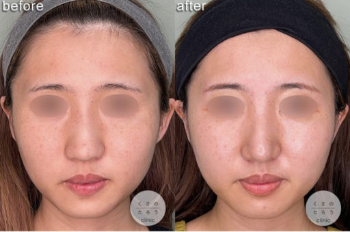 鼻尖形成 耳介軟骨移植 骨切り幅寄せ