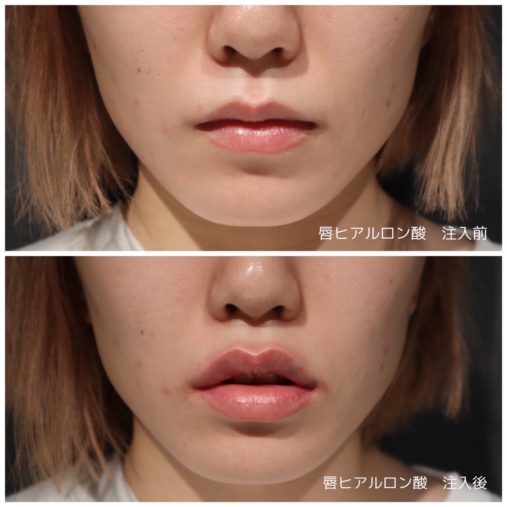 唇ヒアルロン酸