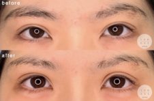 眼瞼下垂<br />
涙袋ヒアルロン酸