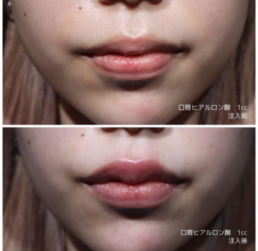 唇ヒアルロン酸