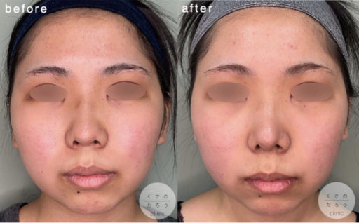 鼻尖形成 耳介軟骨移植