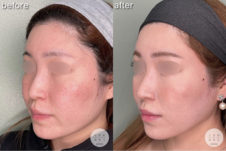 鼻尖形成<br />
耳介軟骨移植