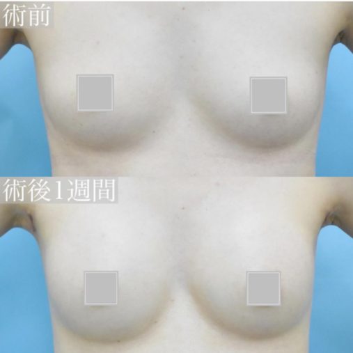 シリコン豊胸