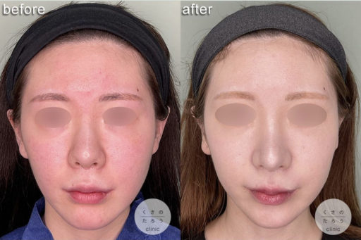 鼻中隔延長 骨切り幅寄せ