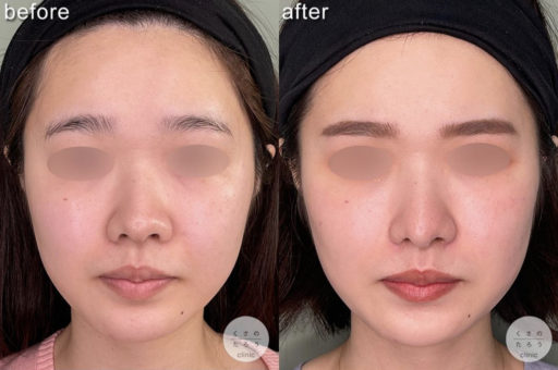 鼻尖形成 耳介軟骨移植 鼻翼形成