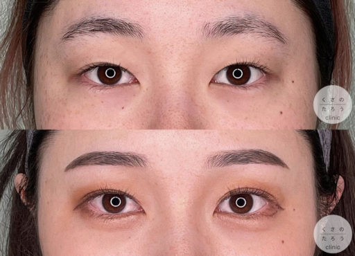 埋没 涙袋ヒアルロン酸